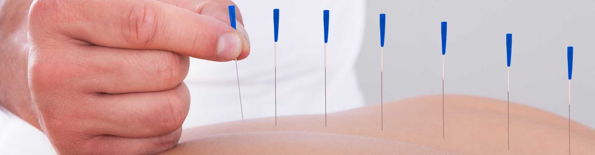 Woman Receiving An Acupuncture Therapy